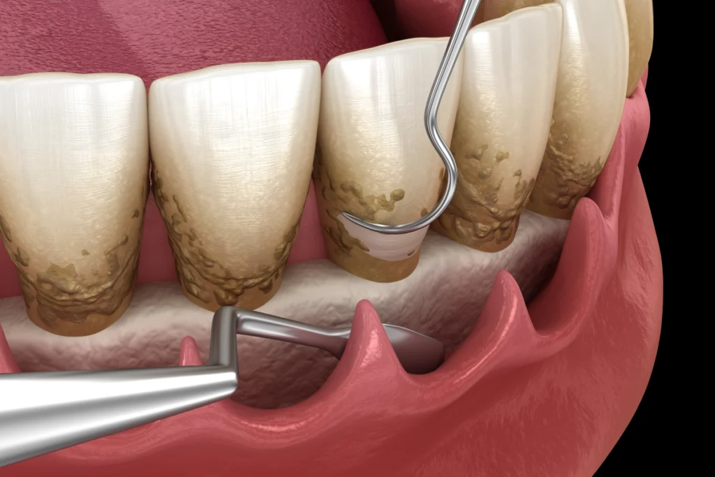 chirurgie assainissement parodontal x Soins des gencives chirurgicaux Dr Pierre Mioche - Dentiste à Clermont-Ferrand