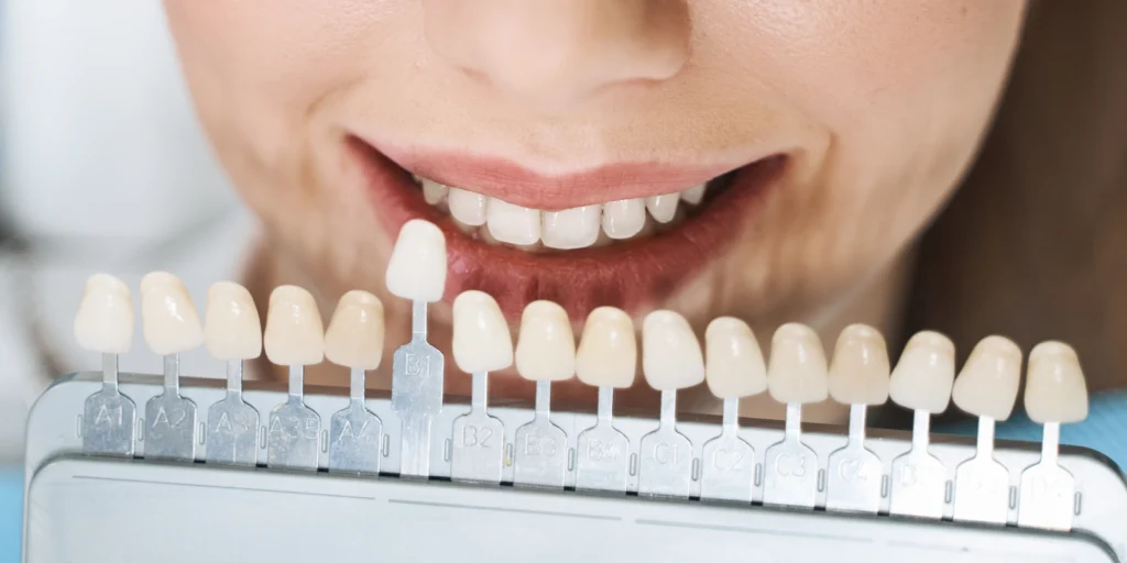 facettes dentaires veneers Facettes dentaires Chirurgiens-dentistes à Meulan-en-Yvelines