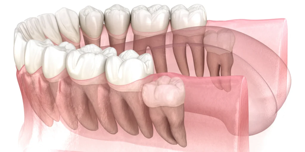 extractions dentaires dents sagesses x Chirurgie orale Dr Johan Cinçon - Chirurgien-dentiste à La Teste-de-Buch