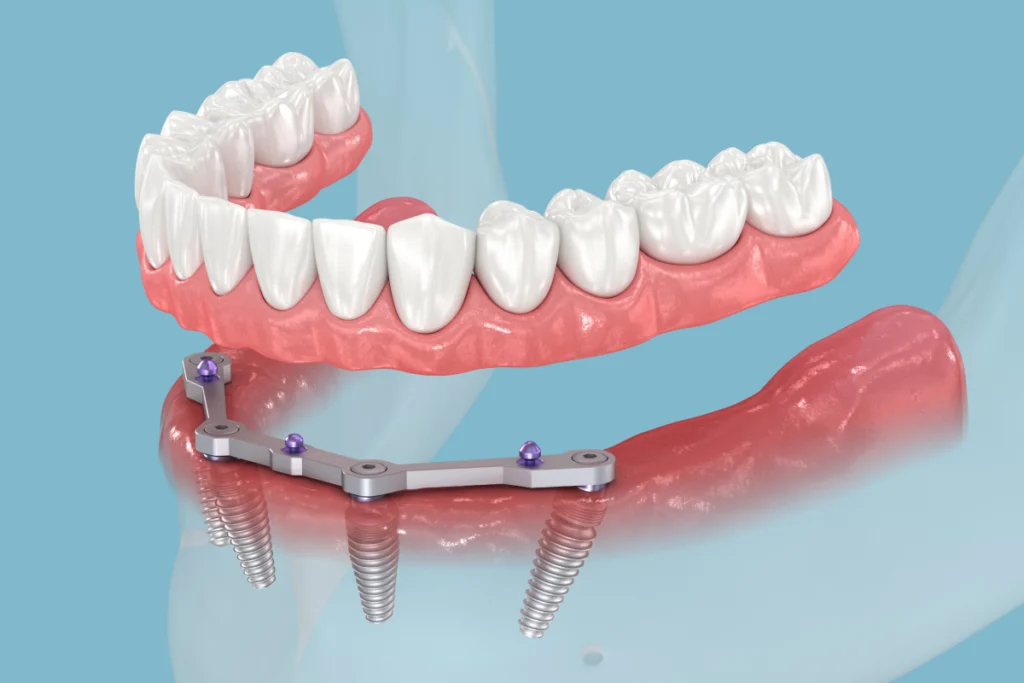implant complet Implants dentaires Chirurgiens-dentistes à Meulan-en-Yvelines