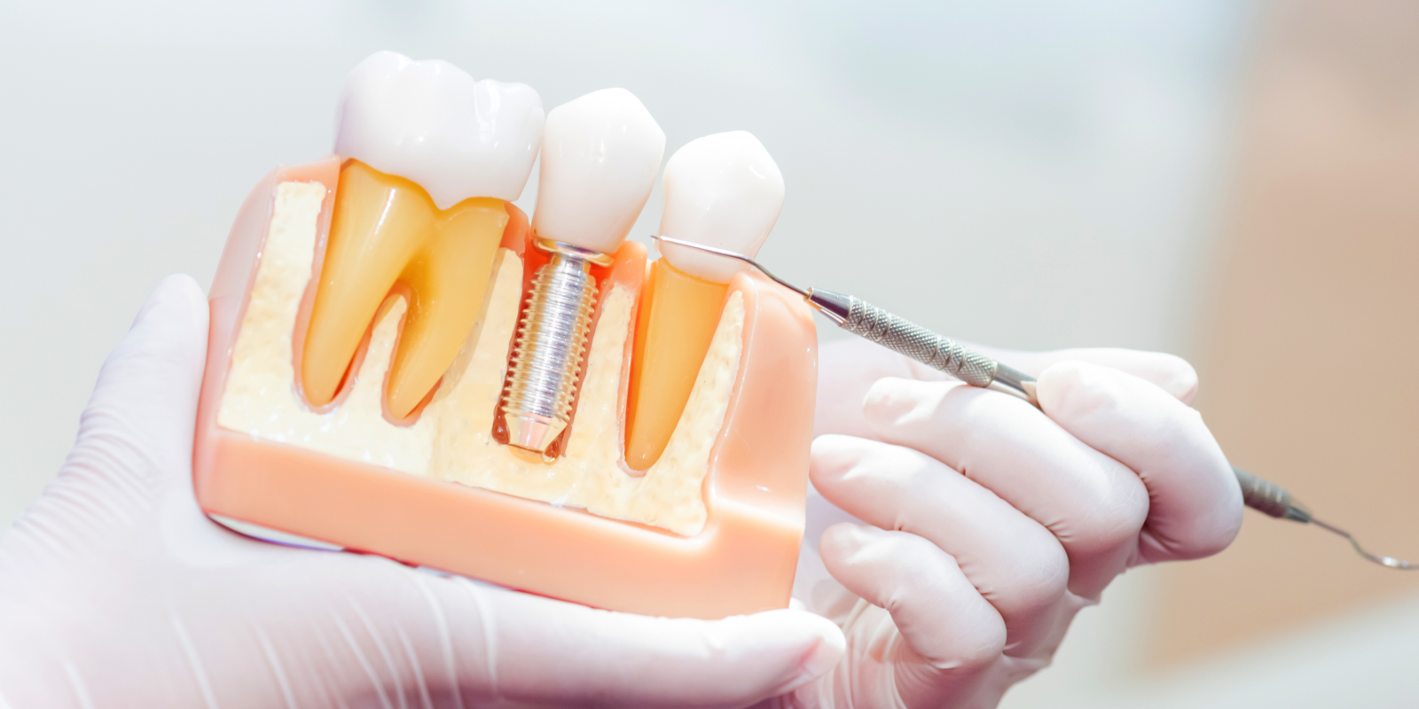 implant dentaire dent manquante Implants dentaires Chirurgiens-dentistes à Meulan-en-Yvelines