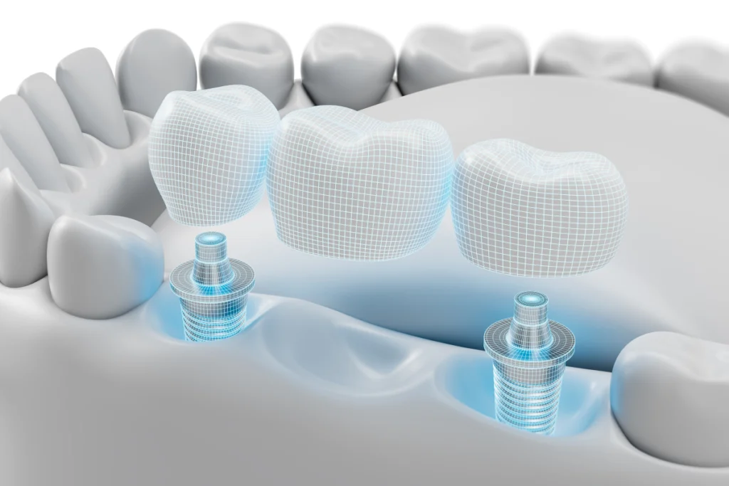 implant dentaire implantation bridge Implants dentaires Chirurgiens-dentistes à Meulan-en-Yvelines